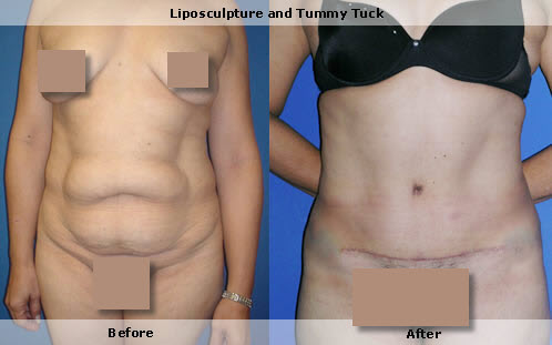 Liposuction,tummy tuck